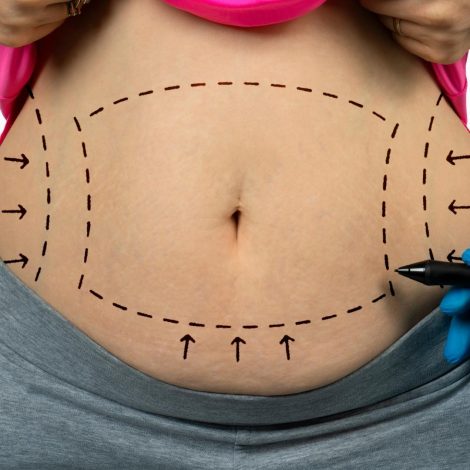 Lipoabdominoplastia