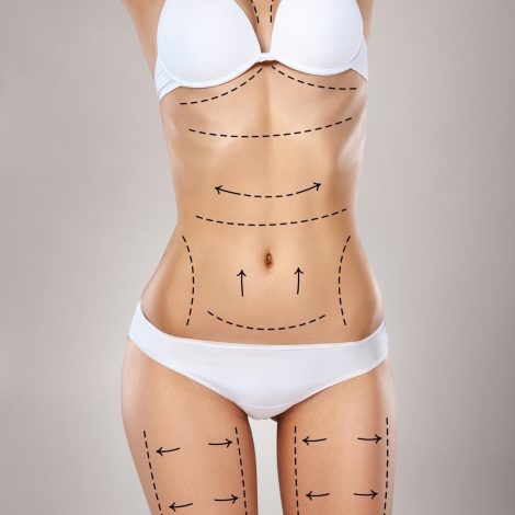 Liposuccion