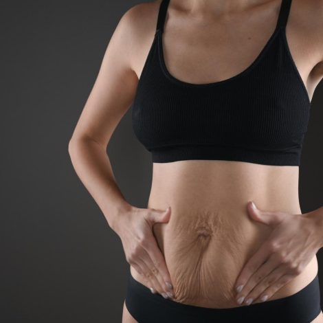 abdominoplastia