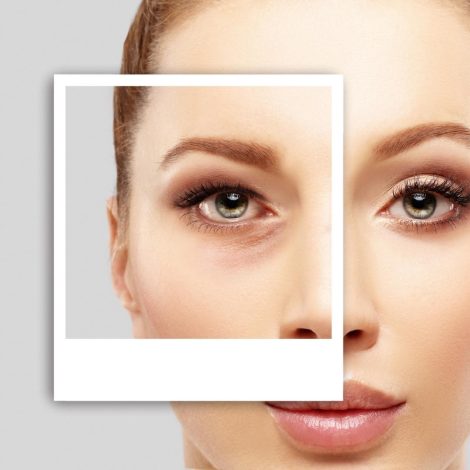 blefaroplastia